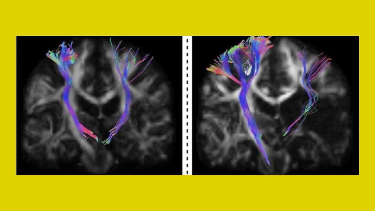 9 Yıldır Felçli Olan Bir Kadın, Yeni Bir Tedavi Yöntemi ile Ellerini Hareket Ettirebildi
