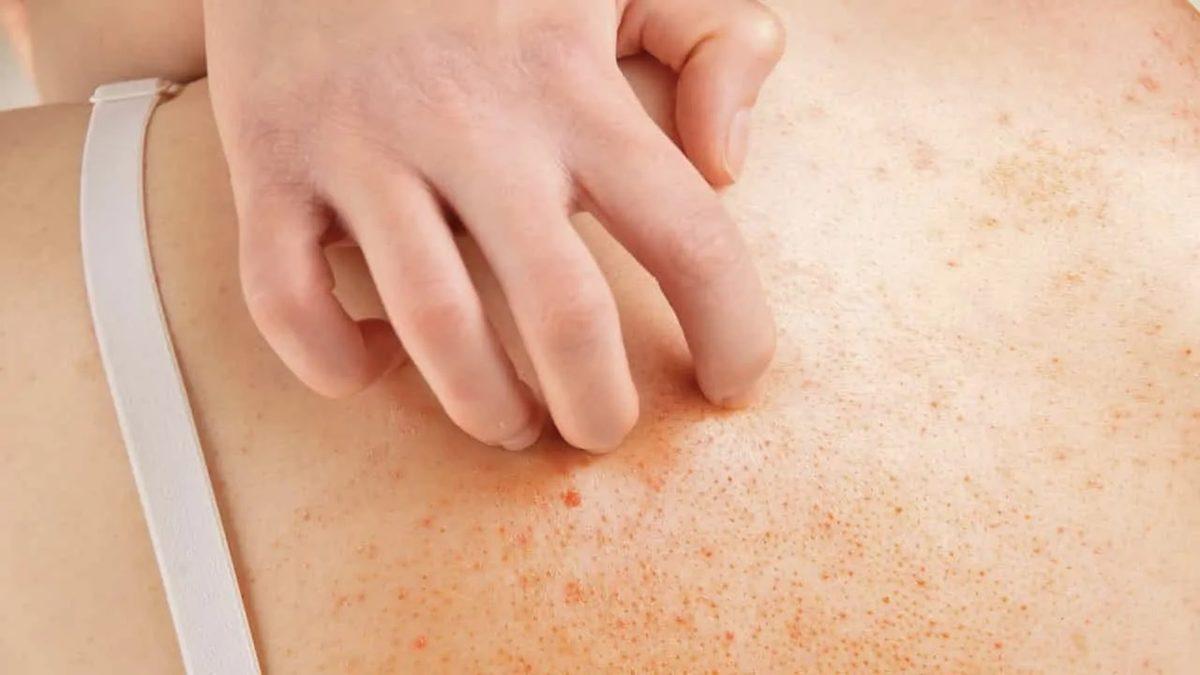 Yaşam Kalitesinin En Büyük Düşmanı Olan ‘Vücutta Kaşıntı’ Neden Olur, Nasıl Geçer?