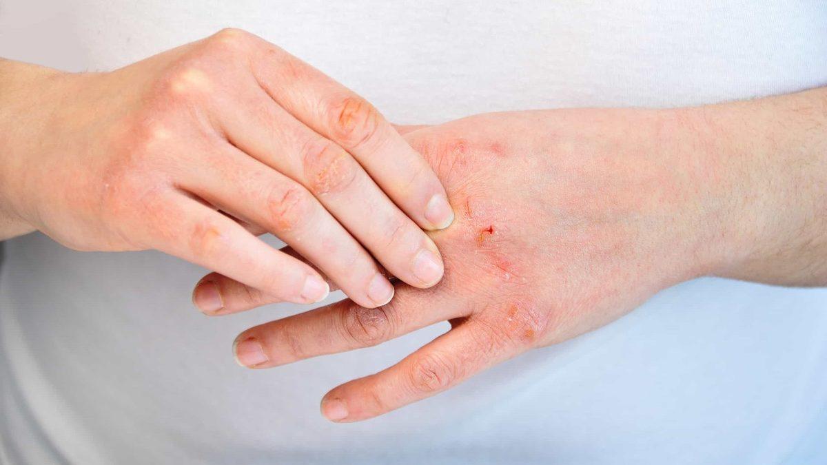 Yaşam Kalitesinin En Büyük Düşmanı Olan ‘Vücutta Kaşıntı’ Neden Olur, Nasıl Geçer?