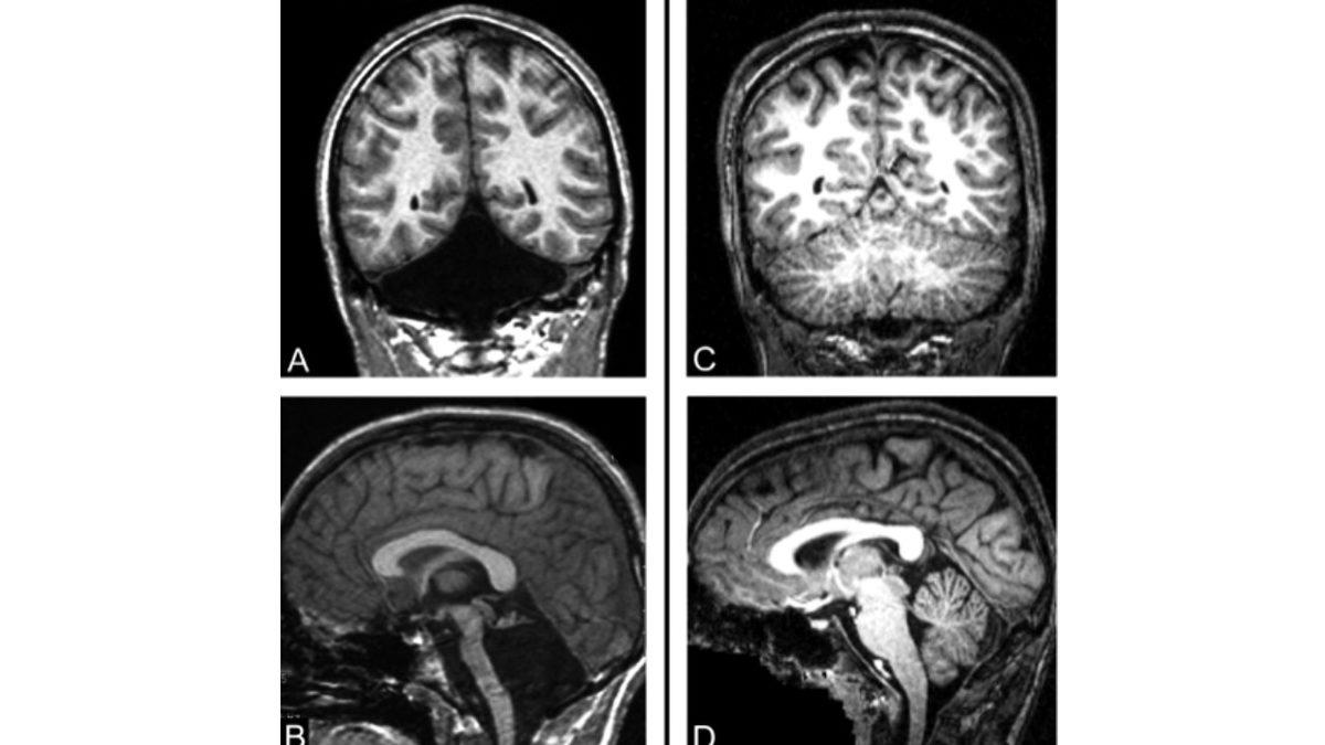 Elinizdeki Telefonu Bile Onun Sayesinde Tuttuğunuz ’Beyincik’ Olmadan Yaşamak Mümkün mü?