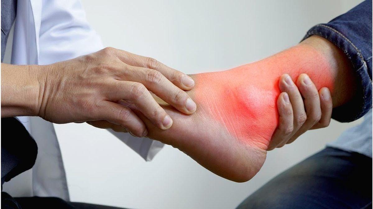 Kralların Hastalığı Olarak Bilinen Gut Hastalığı Nedir, Tedavi Yöntemleri Nelerdir?