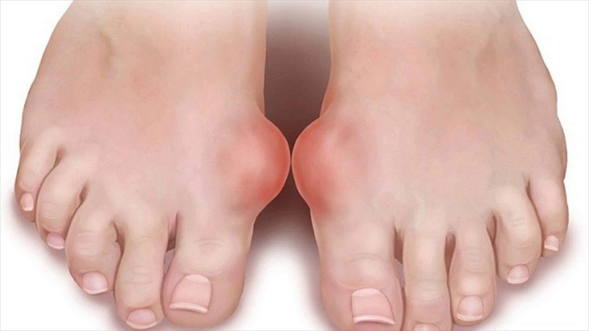 Kralların Hastalığı Olarak Bilinen Gut Hastalığı Nedir, Tedavi Yöntemleri Nelerdir?