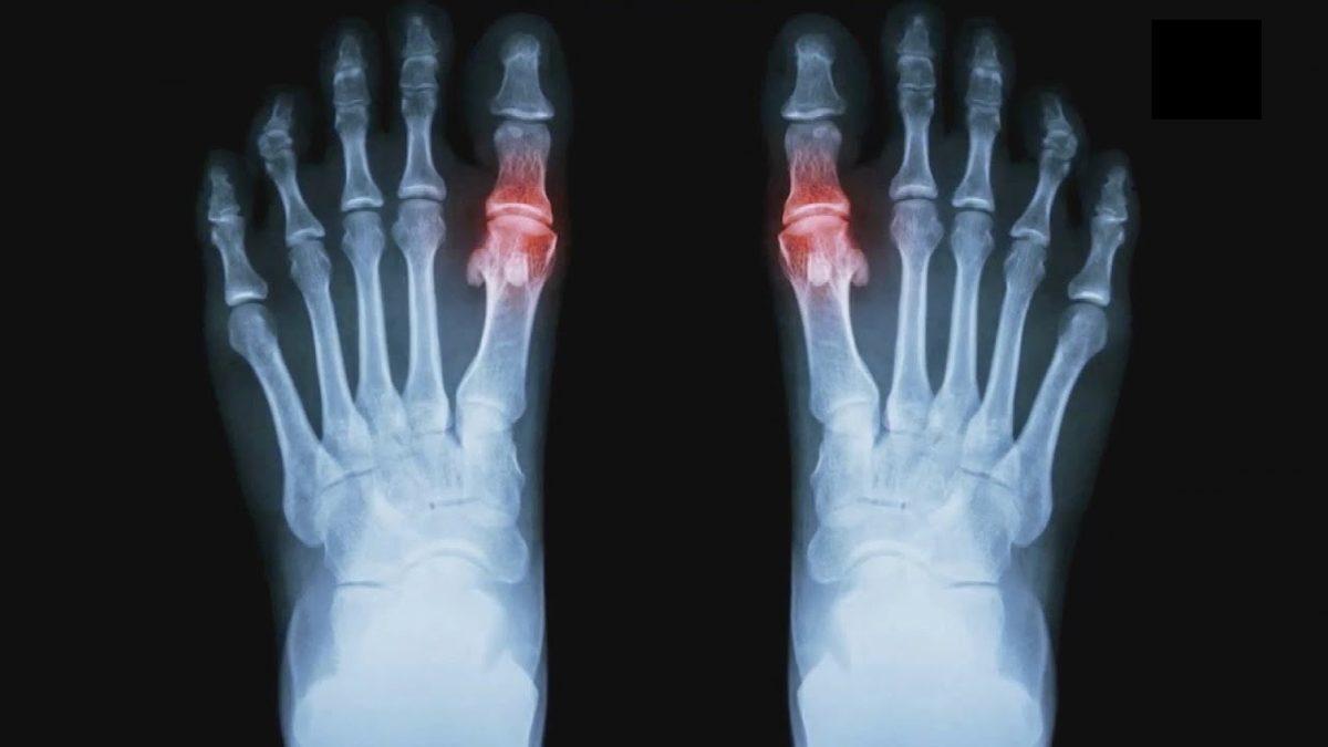 Kralların Hastalığı Olarak Bilinen Gut Hastalığı Nedir, Tedavi Yöntemleri Nelerdir?