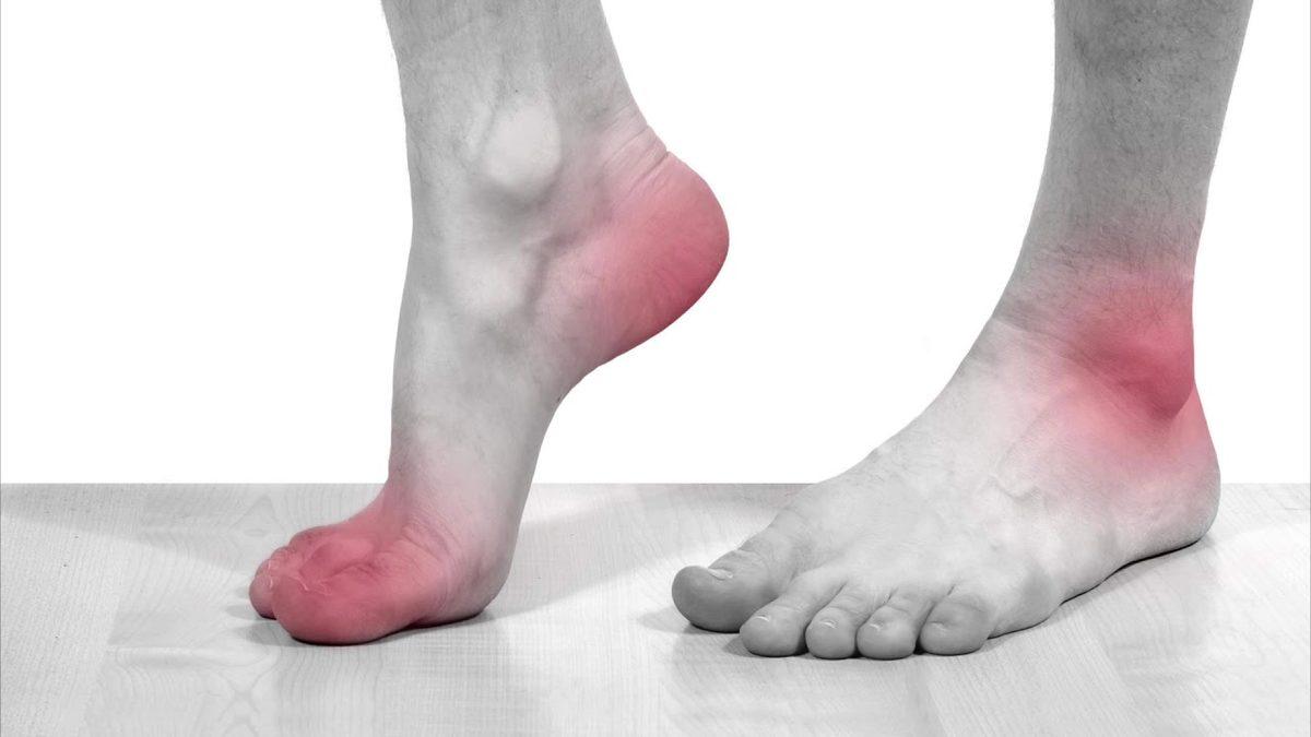 Kralların Hastalığı Olarak Bilinen Gut Hastalığı Nedir, Tedavi Yöntemleri Nelerdir?