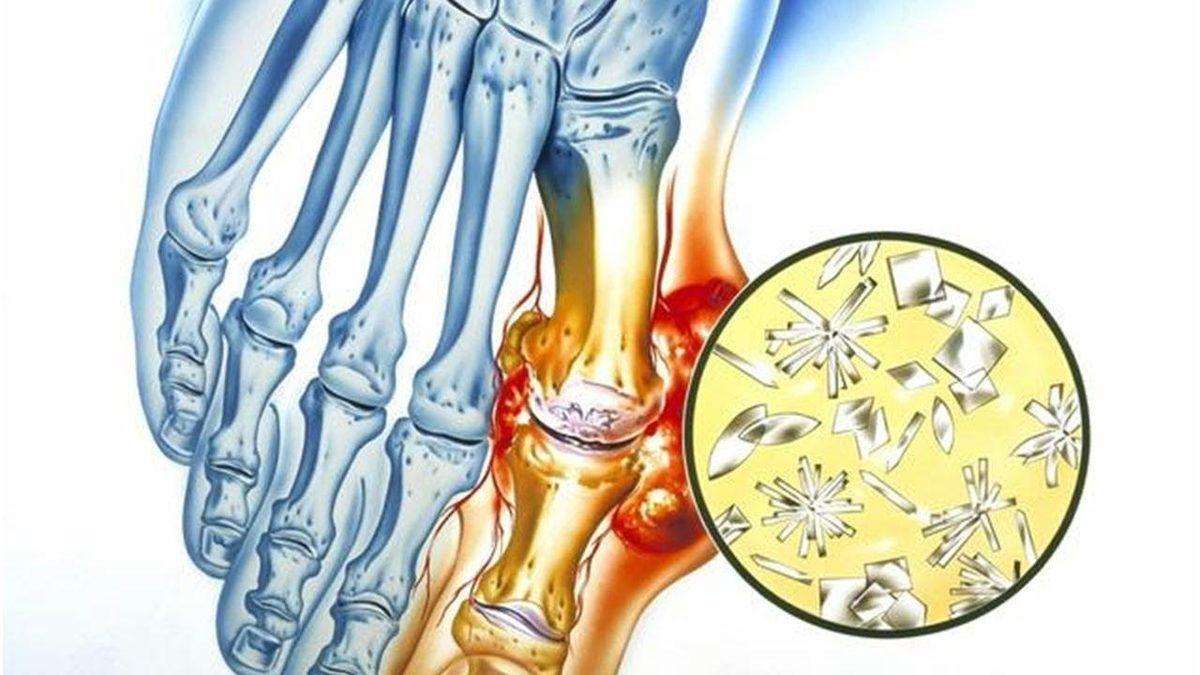 Kralların Hastalığı Olarak Bilinen Gut Hastalığı Nedir, Tedavi Yöntemleri Nelerdir?