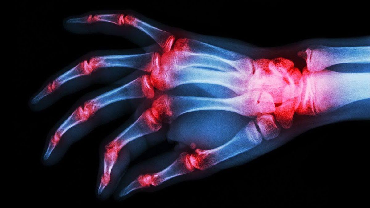 Kralların Hastalığı Olarak Bilinen Gut Hastalığı Nedir, Tedavi Yöntemleri Nelerdir?