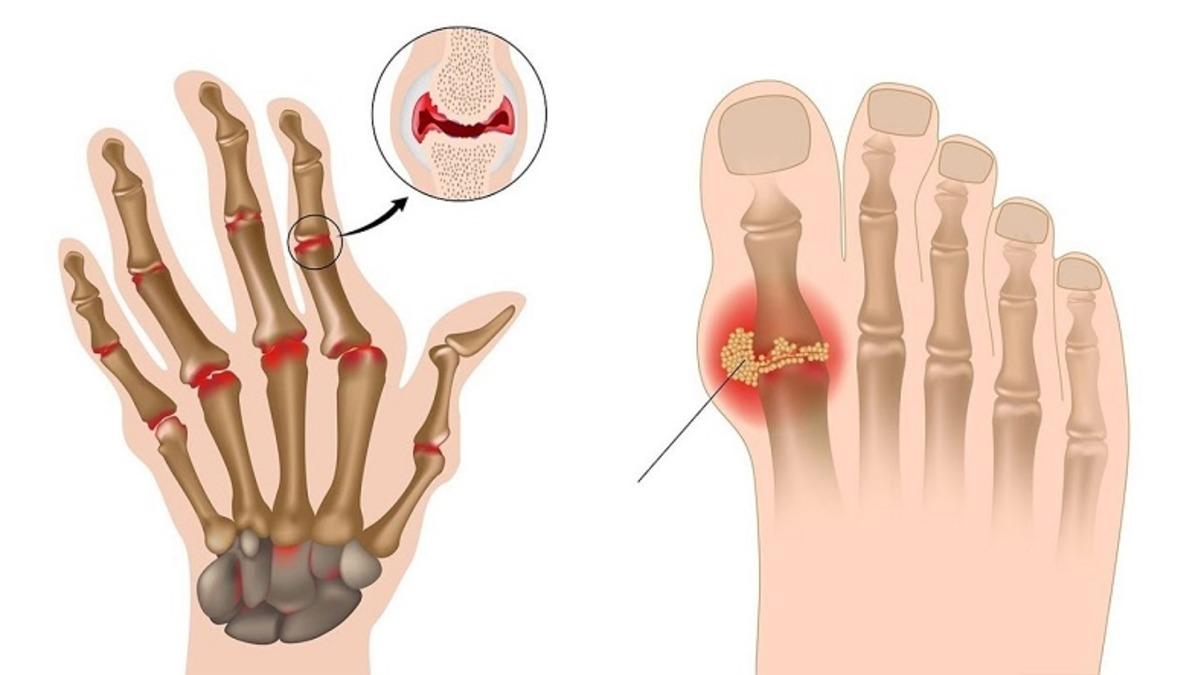 Kralların Hastalığı Olarak Bilinen Gut Hastalığı Nedir, Tedavi Yöntemleri Nelerdir?