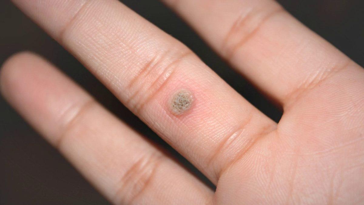 Vücudumuzun Her Noktasında Görülebilen ’Deri Hastalığı’ Siğil Neden Çıkar, Nasıl Tedavi Edilir?