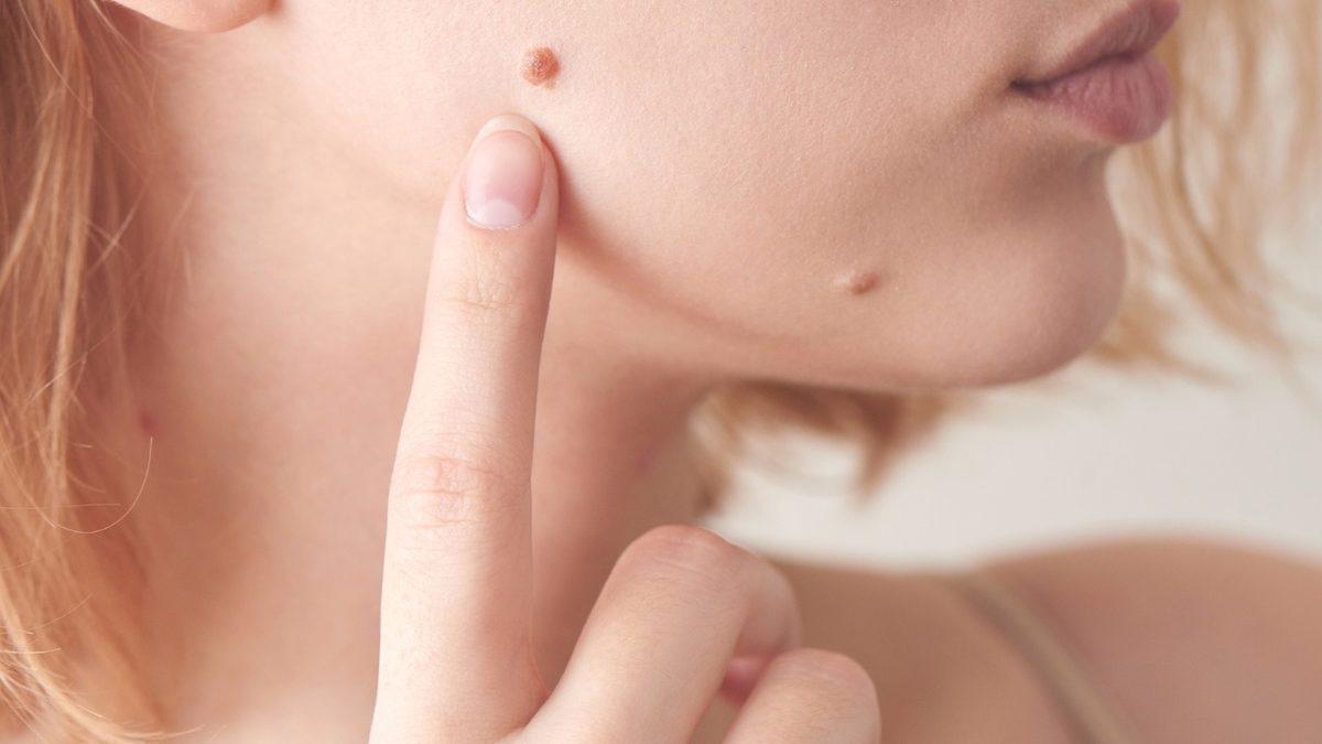 Vücudumuzun Her Noktasında Görülebilen ’Deri Hastalığı’ Siğil Neden Çıkar, Nasıl Tedavi Edilir?