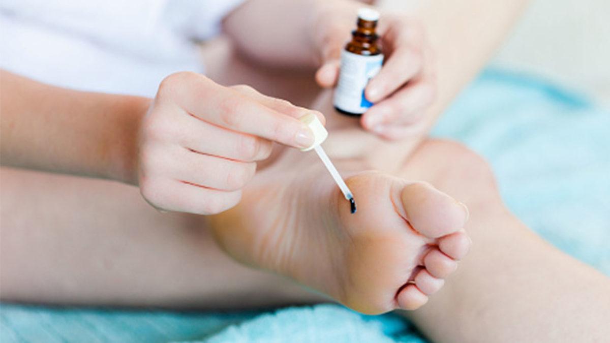 Vücudumuzun Her Noktasında Görülebilen ’Deri Hastalığı’ Siğil Neden Çıkar, Nasıl Tedavi Edilir?