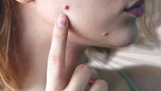 Vücudumuzun Her Noktasında Görülebilen ’Deri Hastalığı’ Siğil Neden Çıkar, Nasıl Tedavi Edilir?