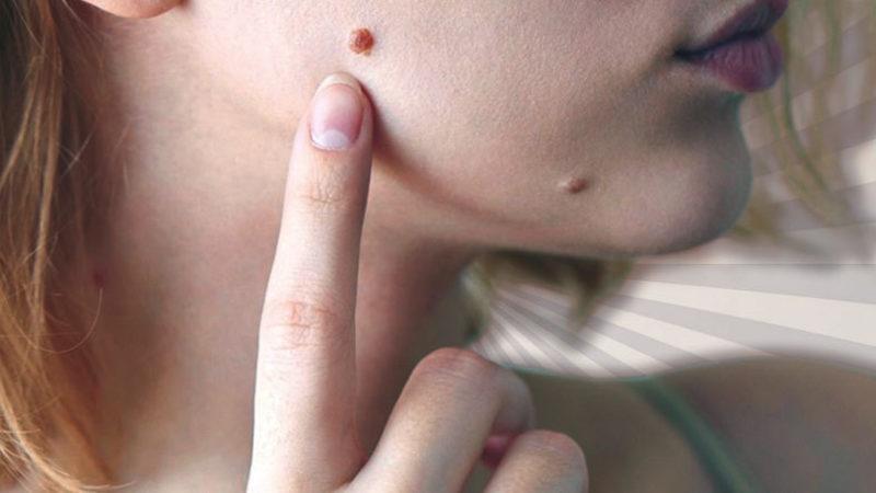 Vücudumuzun Her Noktasında Görülebilen ’Deri Hastalığı’ Siğil Neden Çıkar, Nasıl Tedavi Edilir?