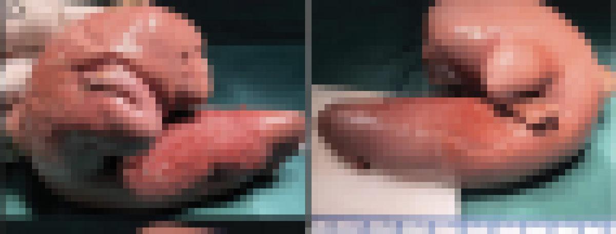 1 Yaşındaki Bebeğin Beyninden, Kendi İkiz Kardeşi Çıkarıldı