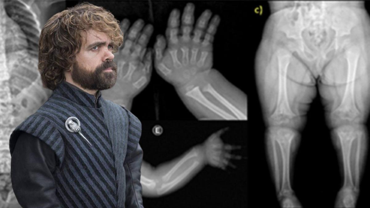 Cücelik Tarih Oluyor: Cüceliğe Karşı Geliştirilen İlk Aşı Onay Aldı