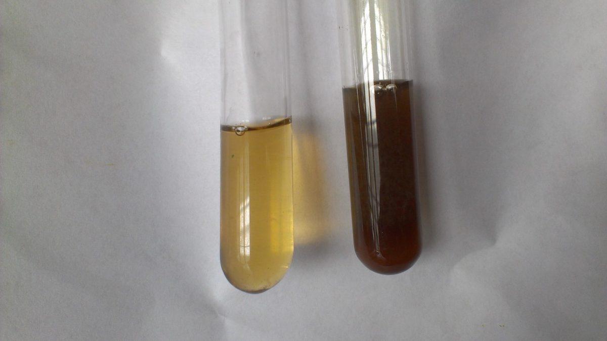 Gözümüzdeki ve Kemiklerimizdeki Beyazlıkları Kömür Gibi Karartan Tuhaf Hastalık: Alkaptonüri