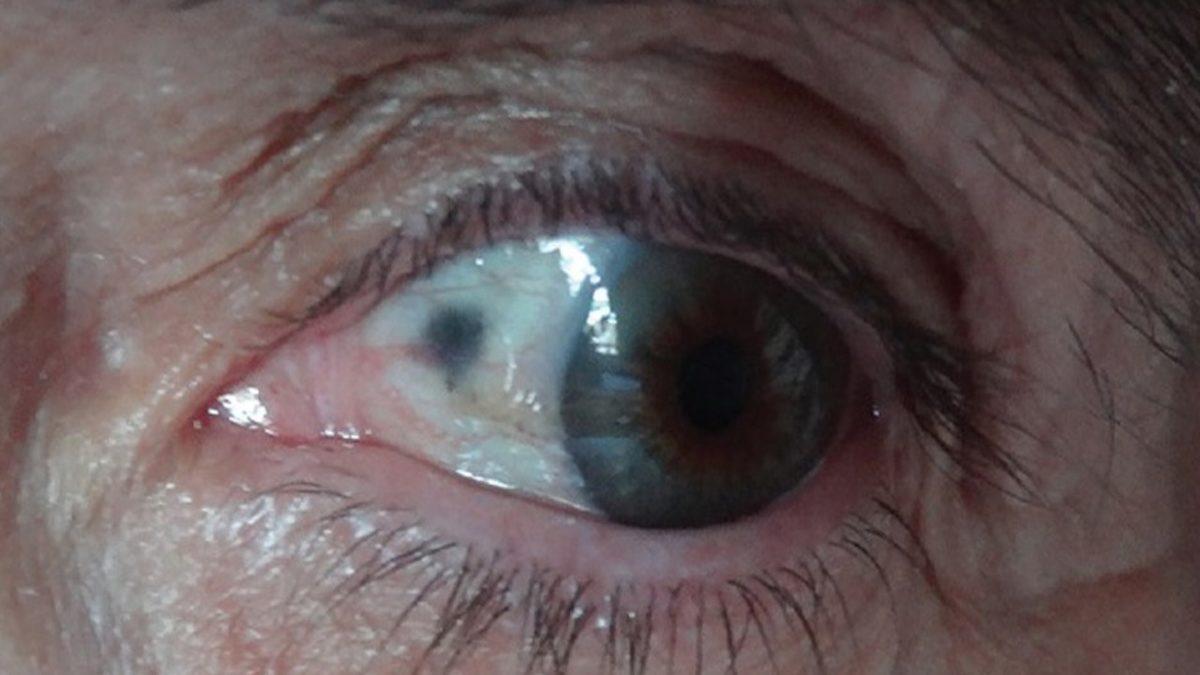 Gözümüzdeki ve Kemiklerimizdeki Beyazlıkları Kömür Gibi Karartan Tuhaf Hastalık: Alkaptonüri