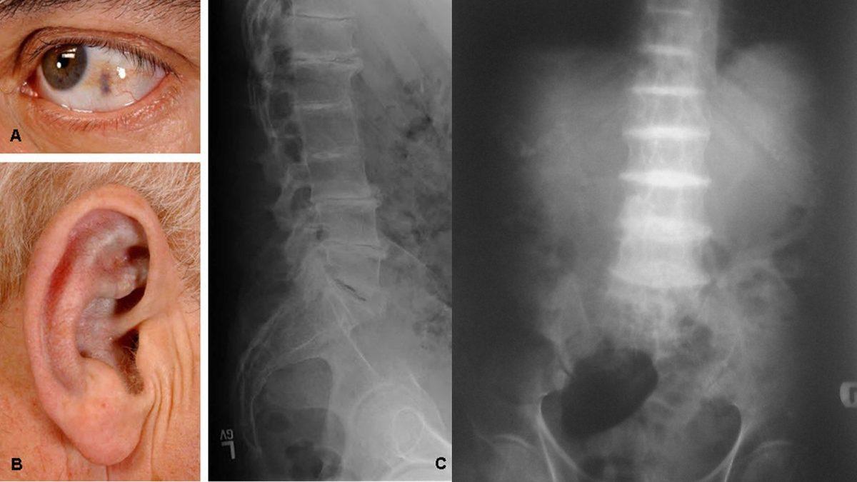 Gözümüzdeki ve Kemiklerimizdeki Beyazlıkları Kömür Gibi Karartan Tuhaf Hastalık: Alkaptonüri