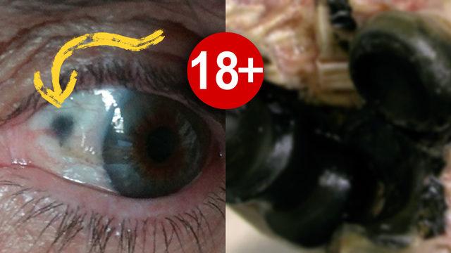 Gözümüzdeki ve Kemiklerimizdeki Beyazlıkları Kömür Gibi Karartan Tuhaf Hastalık: Alkaptonüri