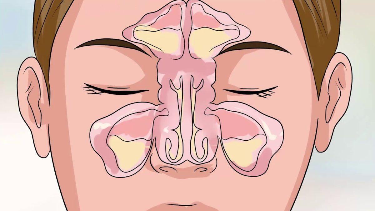 Alerjik Bünyelerin Baş Belası Olan Burun Tıkanıklığını Açmanın 8 Yolu