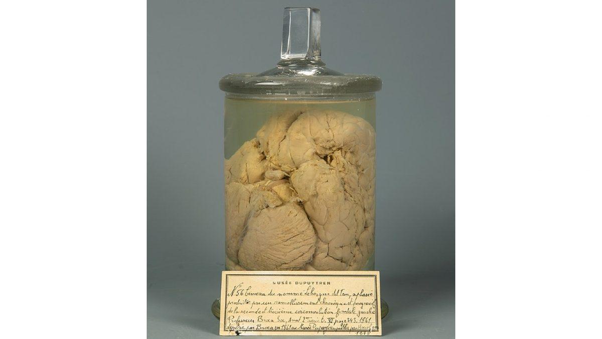 Hayatında Sadece Bir Kelime Konuşabilen Adamın Beyni İncelendiğinde Ortaya Çıkan İlginç Detaylar