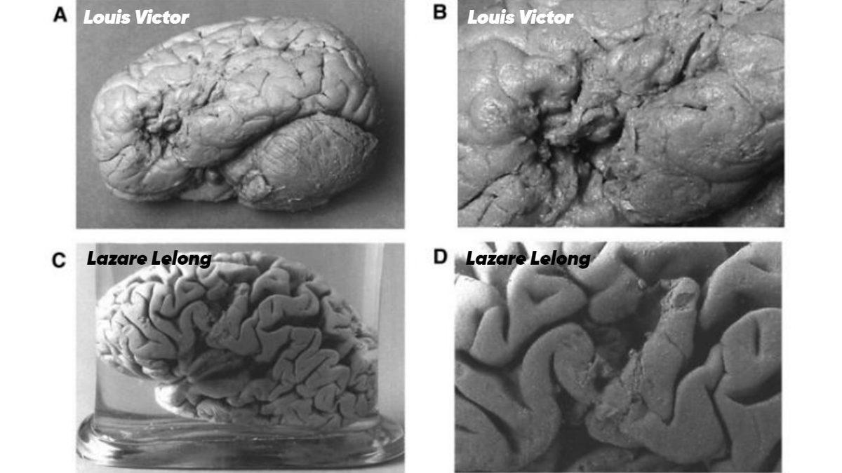 Hayatında Sadece Bir Kelime Konuşabilen Adamın Beyni İncelendiğinde Ortaya Çıkan İlginç Detaylar