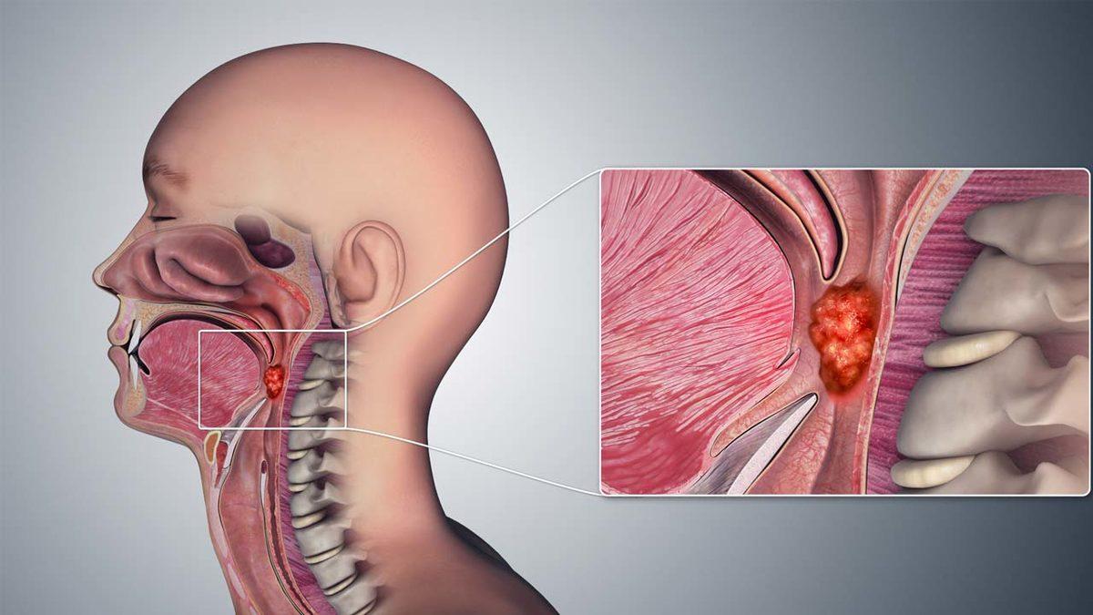 Oral Seksin, Gırtlak Kanserinin En Önemli Nedenlerinden Biri Olduğu Ortaya Çıktı