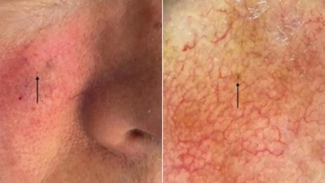 Dünyanın En Küçük Cilt Kanseri Keşfedildi: Çıplak Gözle Görmek Neredeyse İmkânsız