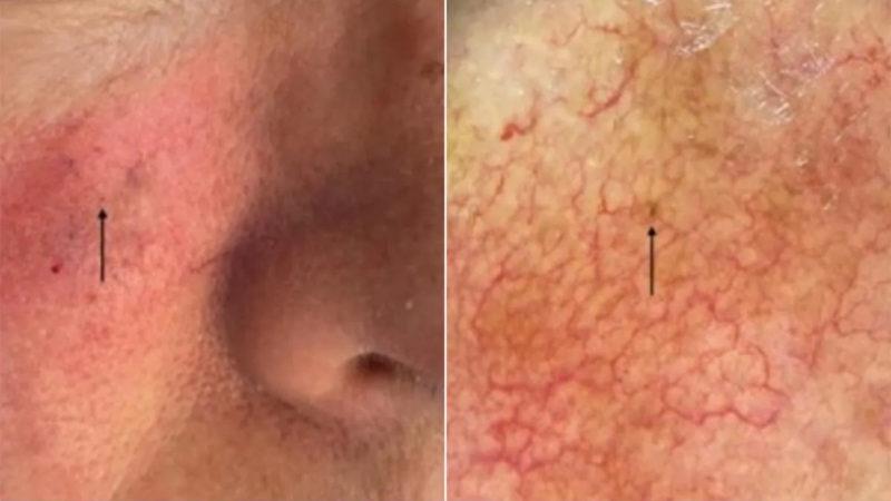 Dünyanın En Küçük Cilt Kanseri Keşfedildi: Çıplak Gözle Görmek Neredeyse İmkânsız