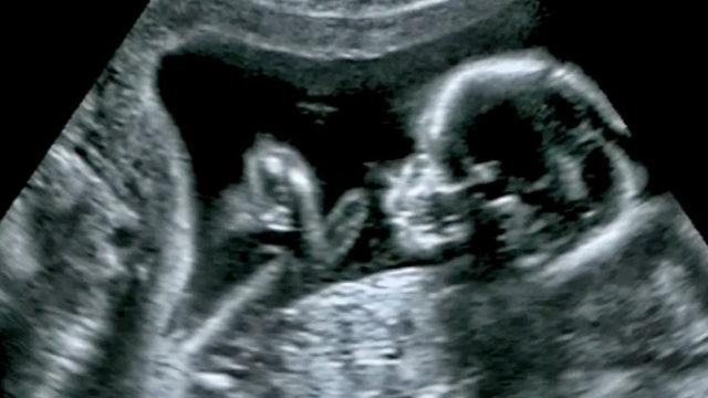 Tıp Tarihinde Bir İlk: Anne Karnındaki Bebeğe Beyin Ameliyatı Yapıldı!