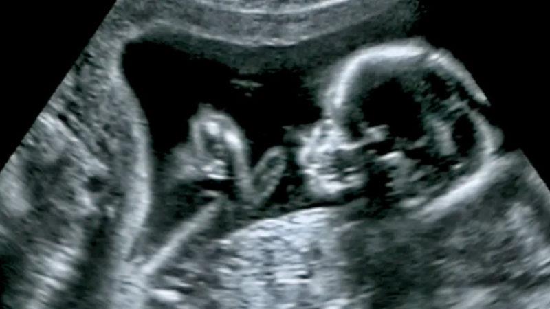 Tıp Tarihinde Bir İlk: Anne Karnındaki Bebeğe Beyin Ameliyatı Yapıldı!