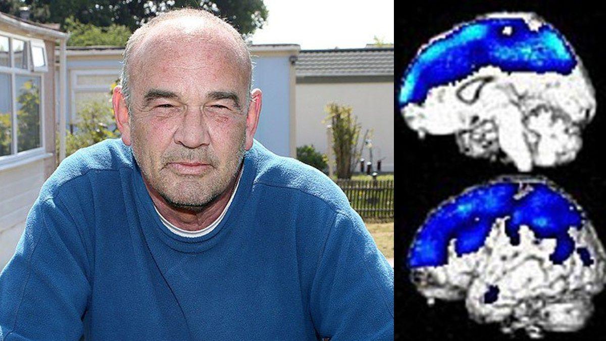 İnsanların Kendilerini Ölü Zannetmelerine Sebep Olan Bozukluk: Yürüyen Ceset Sendromu