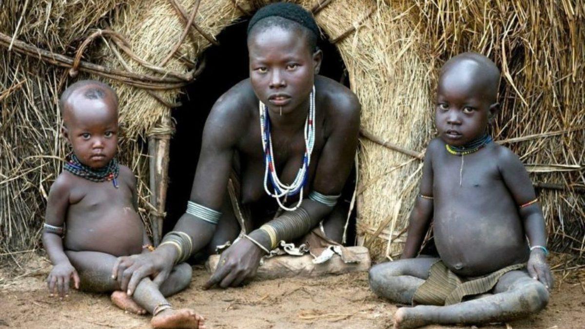 Bu İşte Bir Terslik Var! Açlık Çeken Çocukların Karınları Neden Davul Gibi Şişkindir?