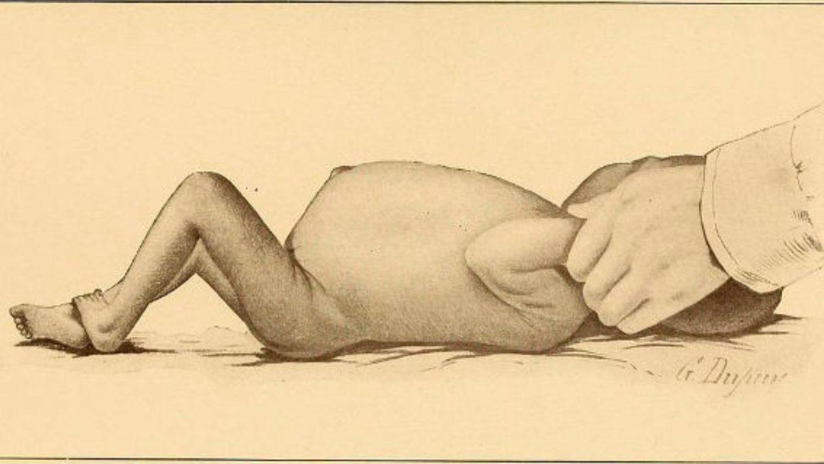 Bu İşte Bir Terslik Var! Açlık Çeken Çocukların Karınları Neden Davul Gibi Şişkindir?