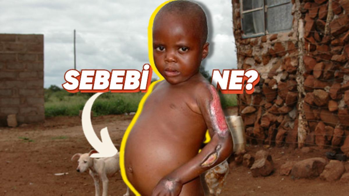 Bu İşte Bir Terslik Var! Açlık Çeken Çocukların Karınları Neden Davul Gibi Şişkindir?