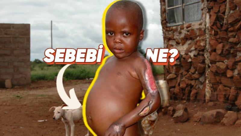 Bu İşte Bir Terslik Var! Açlık Çeken Çocukların Karınları Neden Davul Gibi Şişkindir?