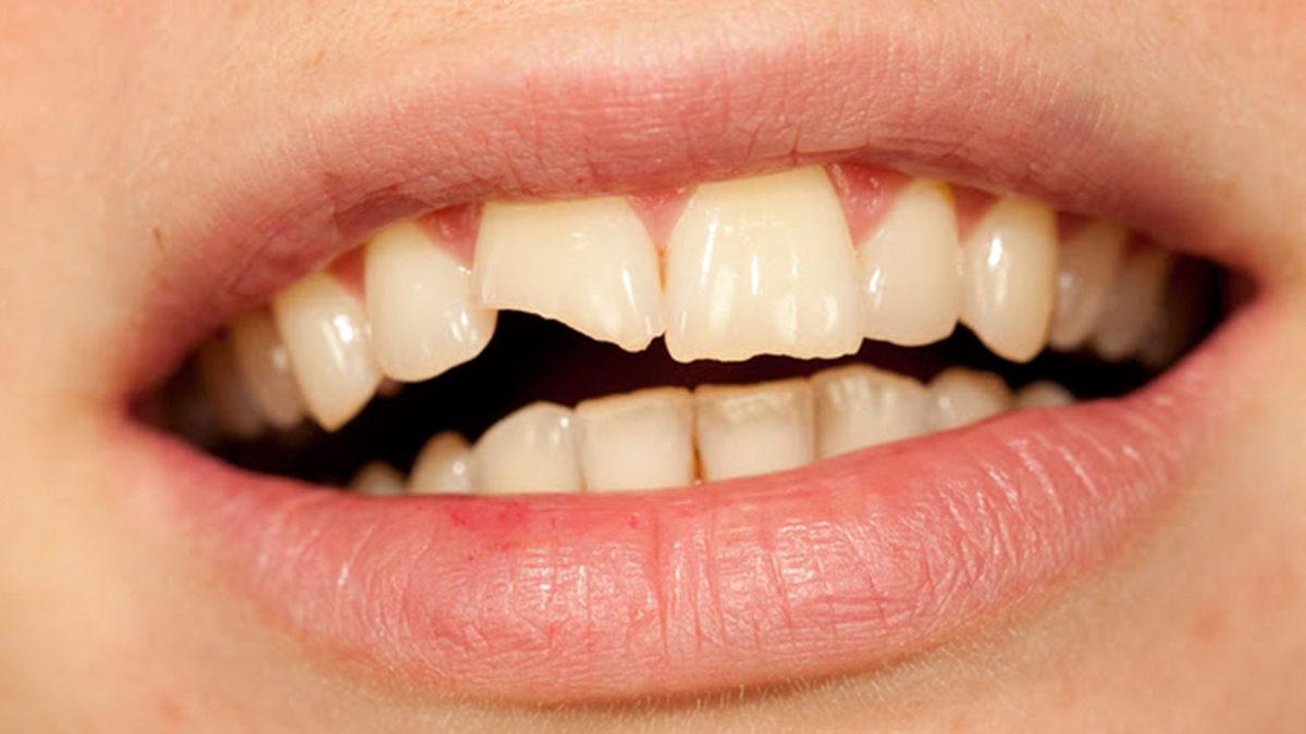 Yaralar, Kemik Kırıkları Kendi Kendine İyileşebilirken Dişler Bu Yetenekten Neden Mahrumdur?