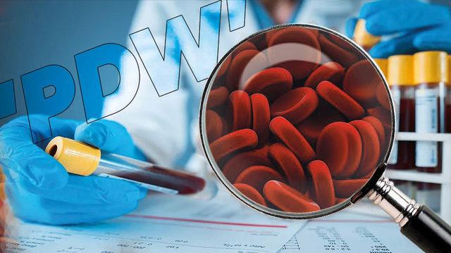 Pek Çok Farklı Kan Hastalığının Habercisi Olabilen PDW Nedir, Düşüklüğü ve Yüksekliği Ne Anlama Gelir?