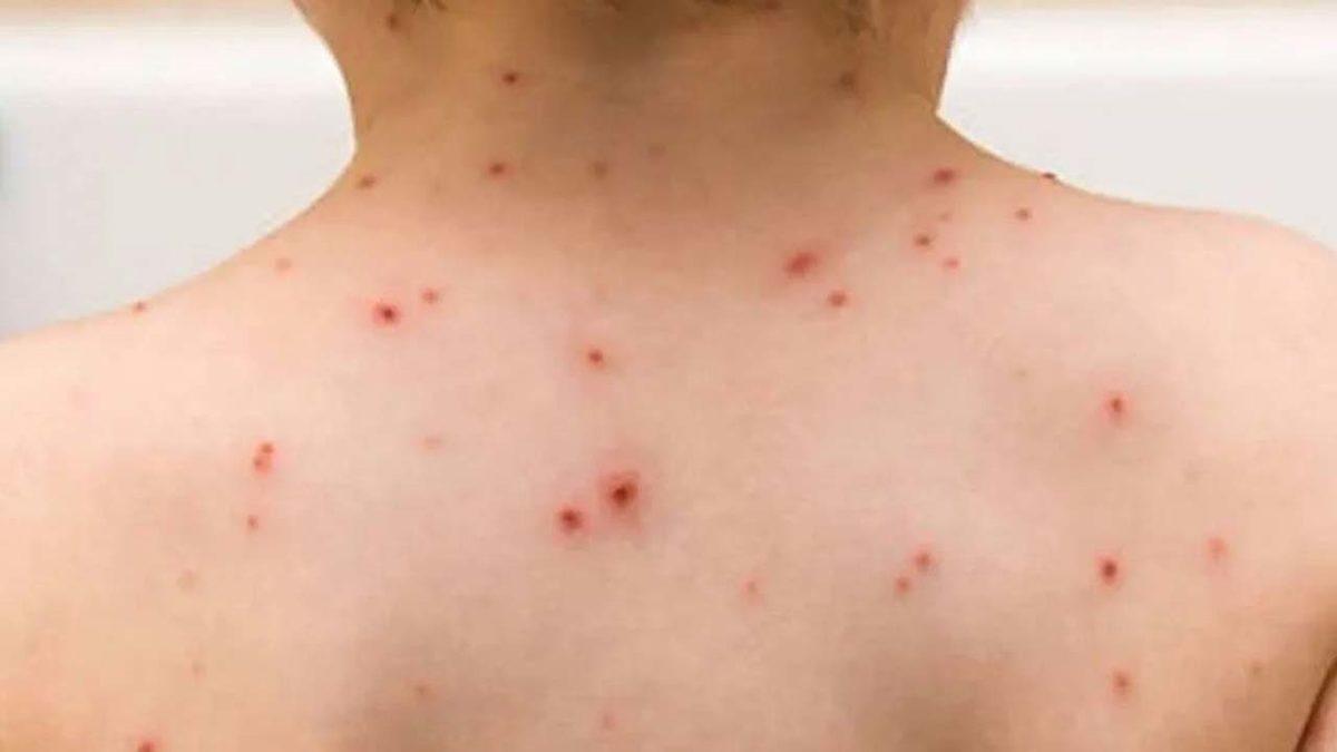 Kızamık Salgını Riskinde Yeni Gelişme: Sağlık Bakanlığı’ndan 81 İle Aşılar Hakkında Talimat