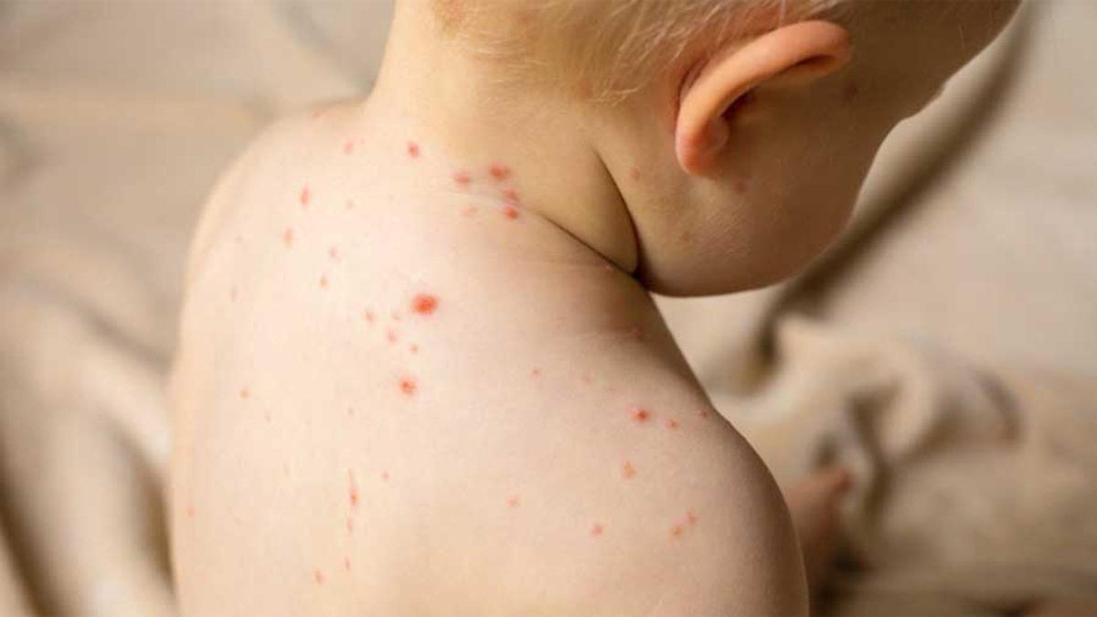 Kızamık Salgını Riskinde Yeni Gelişme: Sağlık Bakanlığı’ndan 81 İle Aşılar Hakkında Talimat