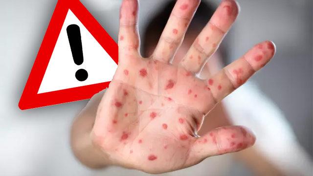 Kızamık Salgını Riskinde Yeni Gelişme: Sağlık Bakanlığı’ndan 81 İle Aşılar Hakkında Talimat