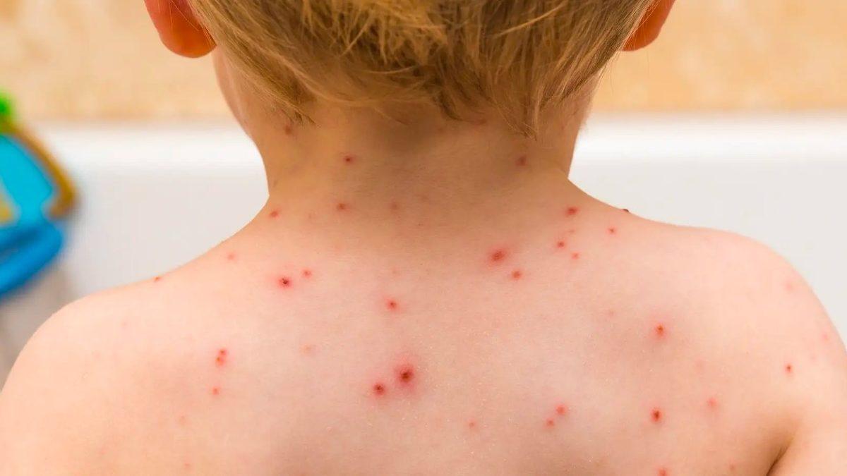 Türkiye’yi Alarma Geçiren Kızamık Salgınının Yeniden Hortlamasına Neden Olan Rahatsız Edici Gerçekler