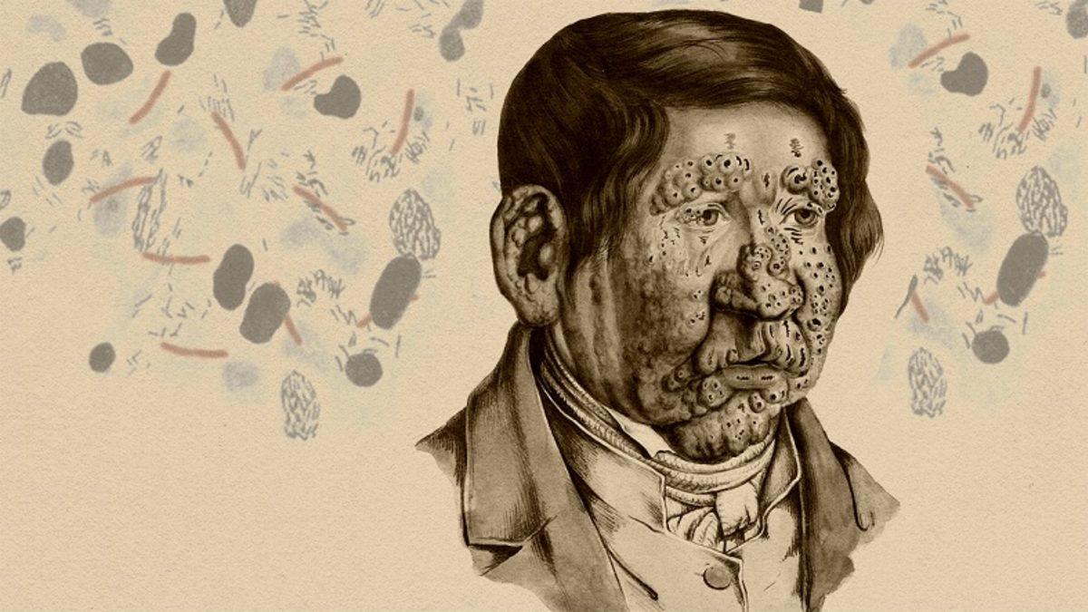 İnsanlık Dışı Yöntemlerle Pek Çok Kişinin Ölüme Terk Edildiği Rahatsızlık Cüzzamın Tarihte Neden Olduğu Karmaşalar