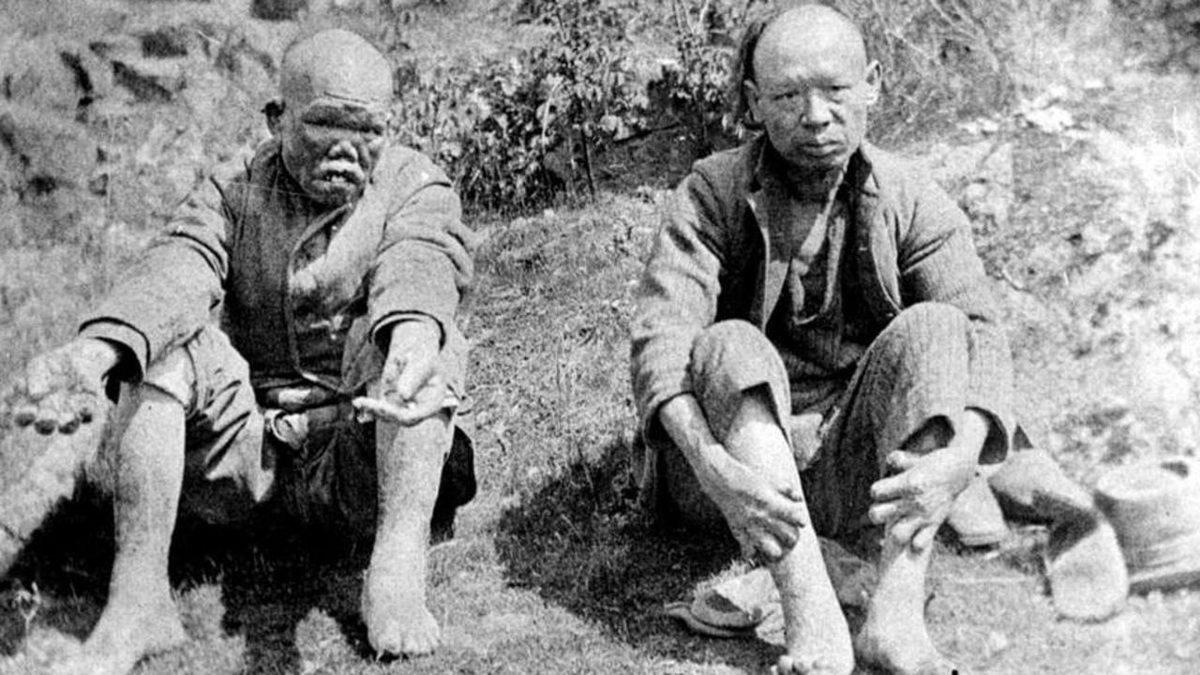 İnsanlık Dışı Yöntemlerle Pek Çok Kişinin Ölüme Terk Edildiği Rahatsızlık Cüzzamın Tarihte Neden Olduğu Karmaşalar