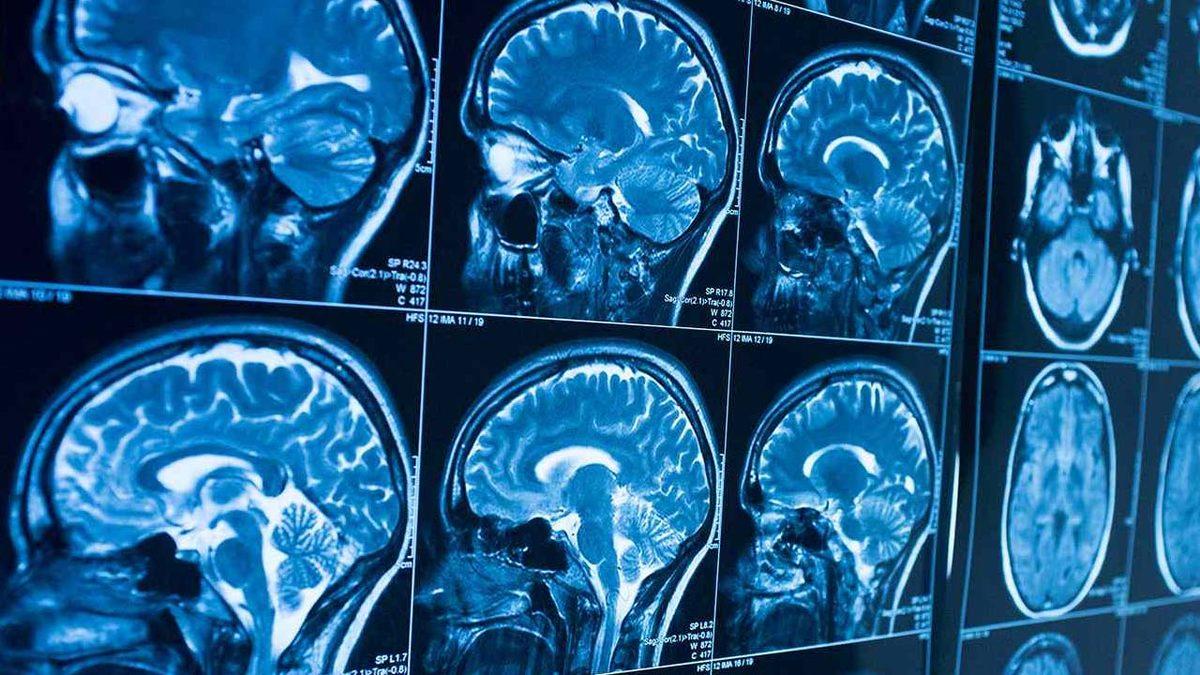 Tarihte İlk Kez Bir Kadın, Yaptığı Spor Nedeniyle Beyin Hücrelerinde Azalma Yaşadı: Peki Bu Ne Anlama Geliyor?