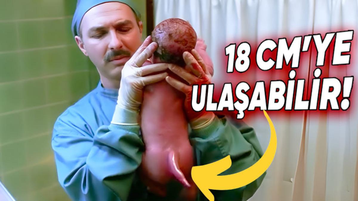 Bazı Bebekler Nasıl Oluyor da Kuyruk Benzeri Bir Yapıyla Dünyaya Gelebiliyor?