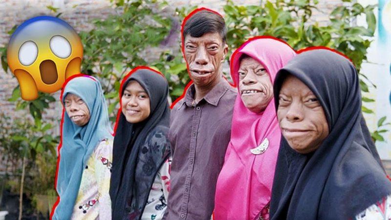 Tuhaf Görünüşleri Yüzünden Lanetli Olduklarına İnanılan ’Kertenkele Surat’ Lakaplı Aile: Teşhis İçin Doktora Bile Gitmemişler!