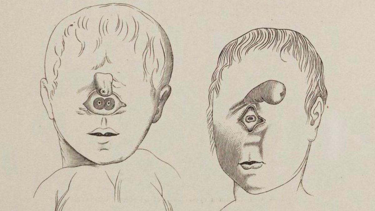 Tek Gözlü Bebeklere Neden Olan Bu Doğum Kusuru, Hangi Sebeplerden Dolayı Ortaya Çıkıyor?