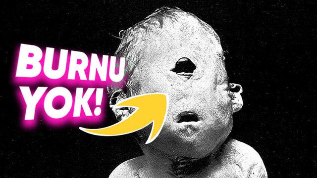 Tek Gözlü Bebeklere Neden Olan Bu Doğum Kusuru, Hangi Sebeplerden Dolayı Ortaya Çıkıyor?