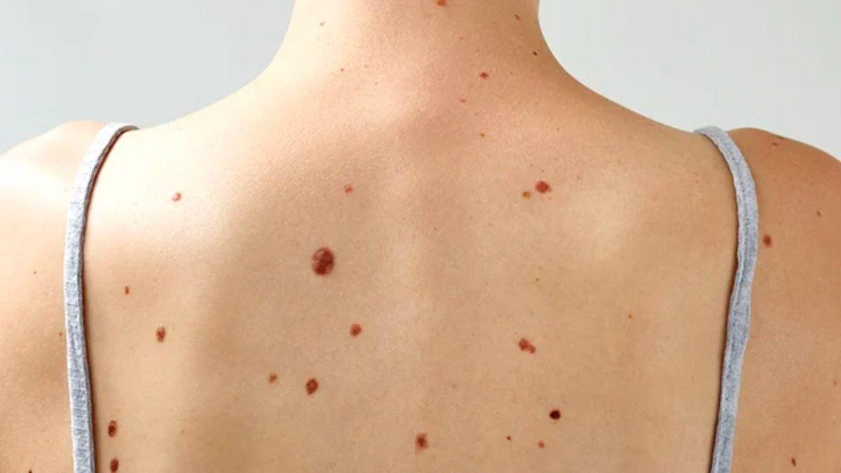 Hemen O Noktaya Bakmak İsteyeceksiniz: Nasıl Oluyor da Çoğumuzun Tam Aynı Yerinde Bu Küçük Benlerden Çıkabiliyor?