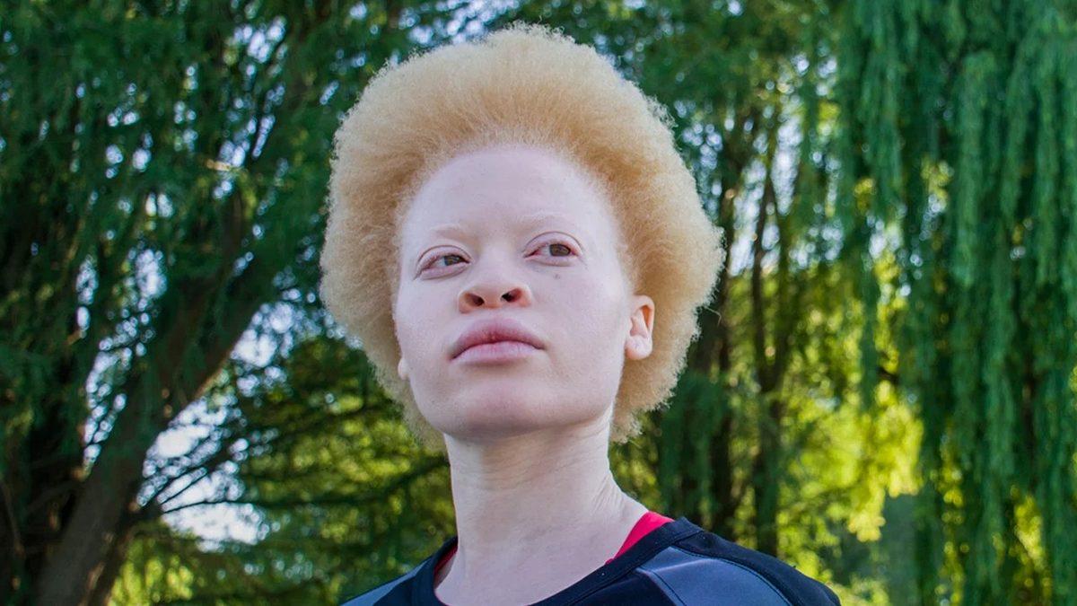 Saç ve Ciltte Renk Farklılığına Neden Olan Albino Hastalığı Nedir, Neden Olur, Kalıtsal mıdır?